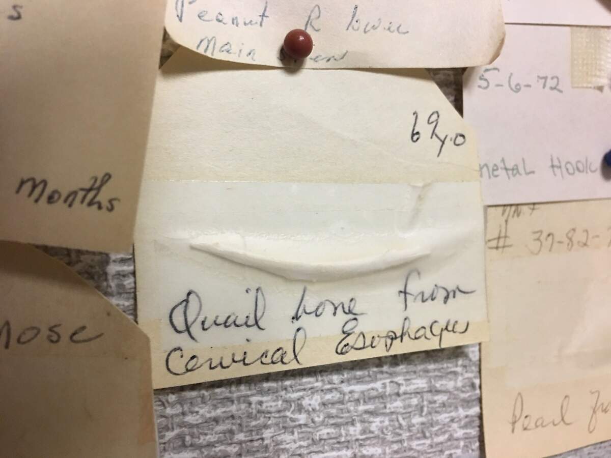 A quail bone stuck in the esophagus of a 69-year-old woman, one of the exhibits on display at UNC Hospitals' ear, nose and throat department.