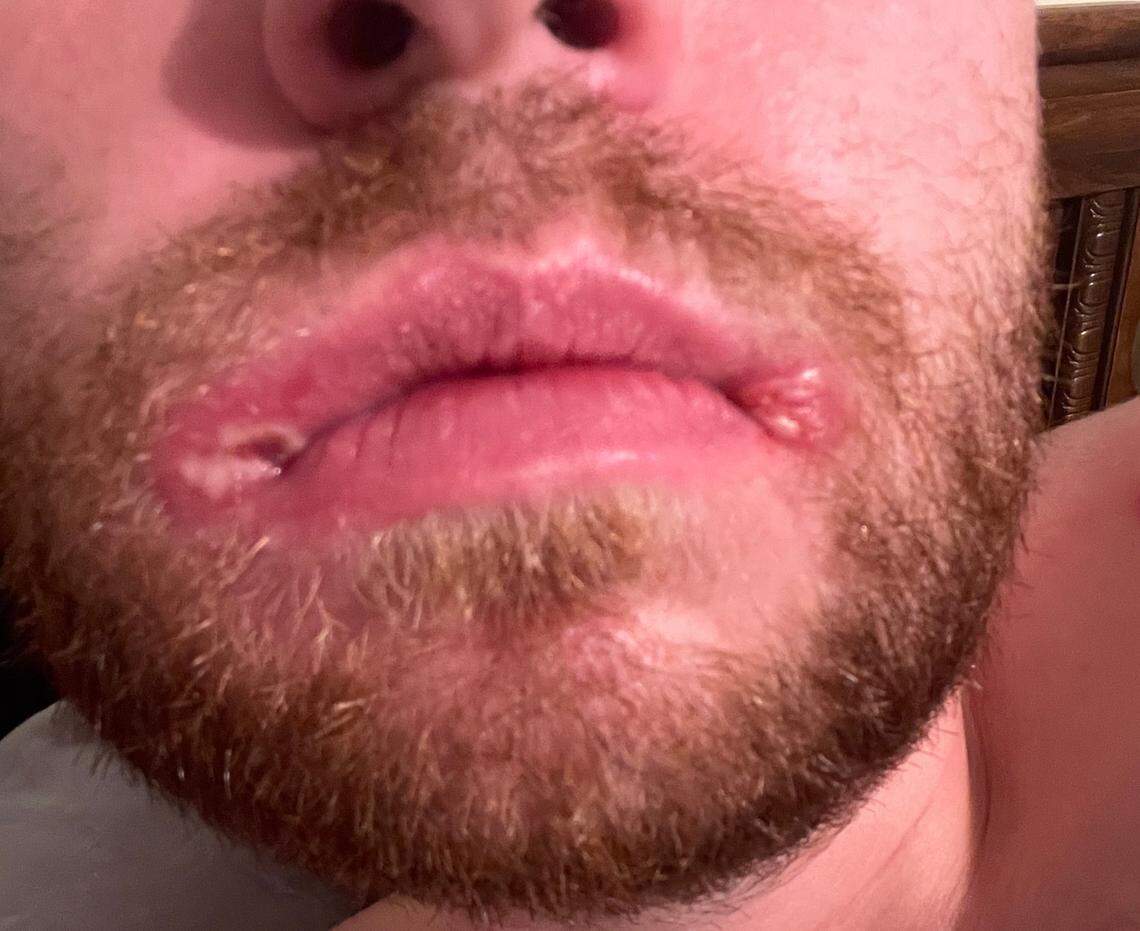 The 29-year-old man was diagnosed with mpox after days of searching for a test. Lesions around the mouth are one of the symptoms of the virus.