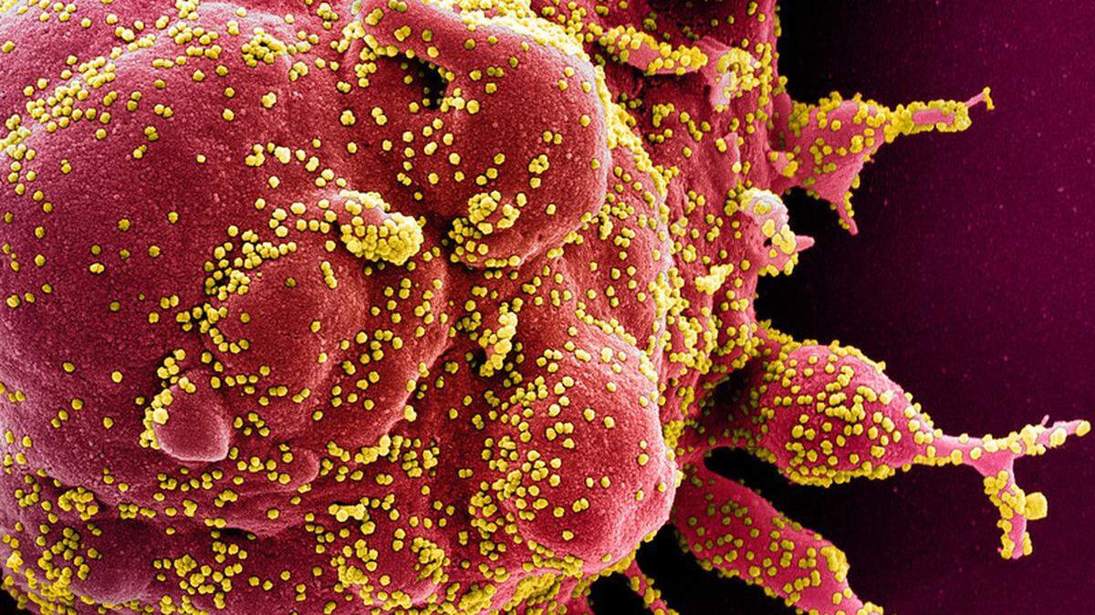 Colorized scanning electron micrograph of an apoptotic cell (red) heavily infected with SARS-COV-2 virus particles (yellow), isolated from a patient sample. Image captured at the NIAID Integrated Research Facility (IRF) in Fort Detrick, Maryland.