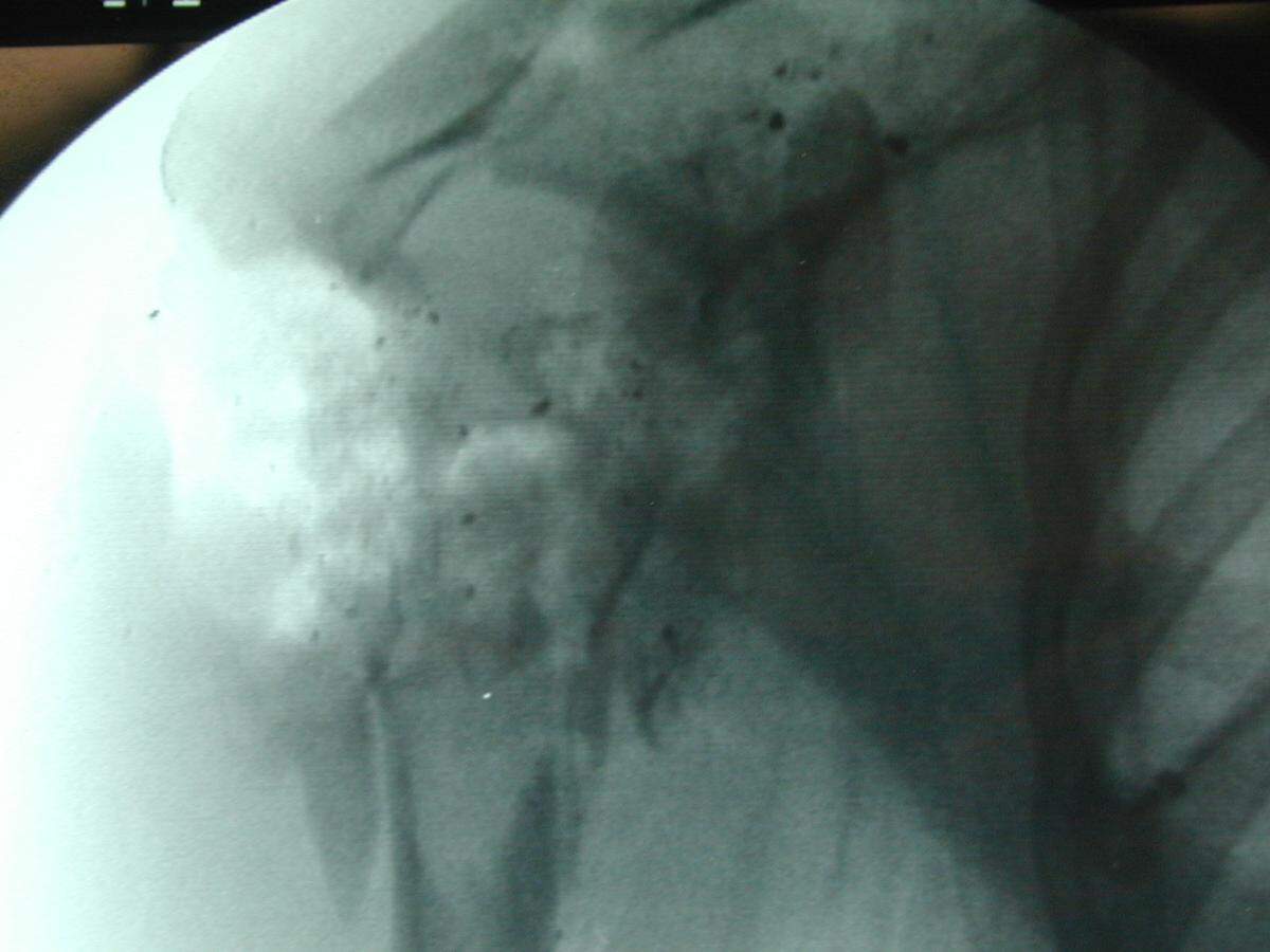 Kacey Ruegsegger Johnson survived the Columbine High School shooting in 1999. She provided this X-ray of her shoulder. The bullet went through her shoulder, grazed her neck and then through her thumb, which was plugging her ear. “In the X-ray it just looks like a cloud of dust. You wouldn’t even be able to recognize that was a shoulder before,” she said.