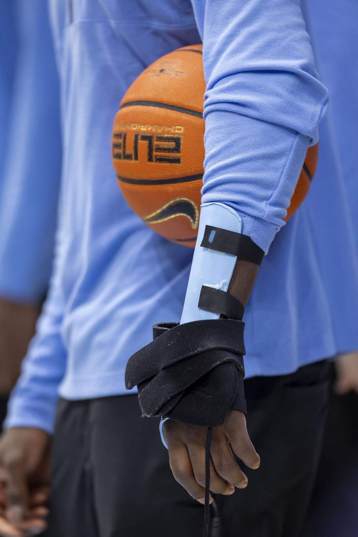 North Carolina forward Caleb Wilson’s injured left hand, on Saturday, February 14, 2026 at the Smith Center in Chapel Hill, N.C. Wilson is sidelined after fracturing his left hand in the game against Miami.