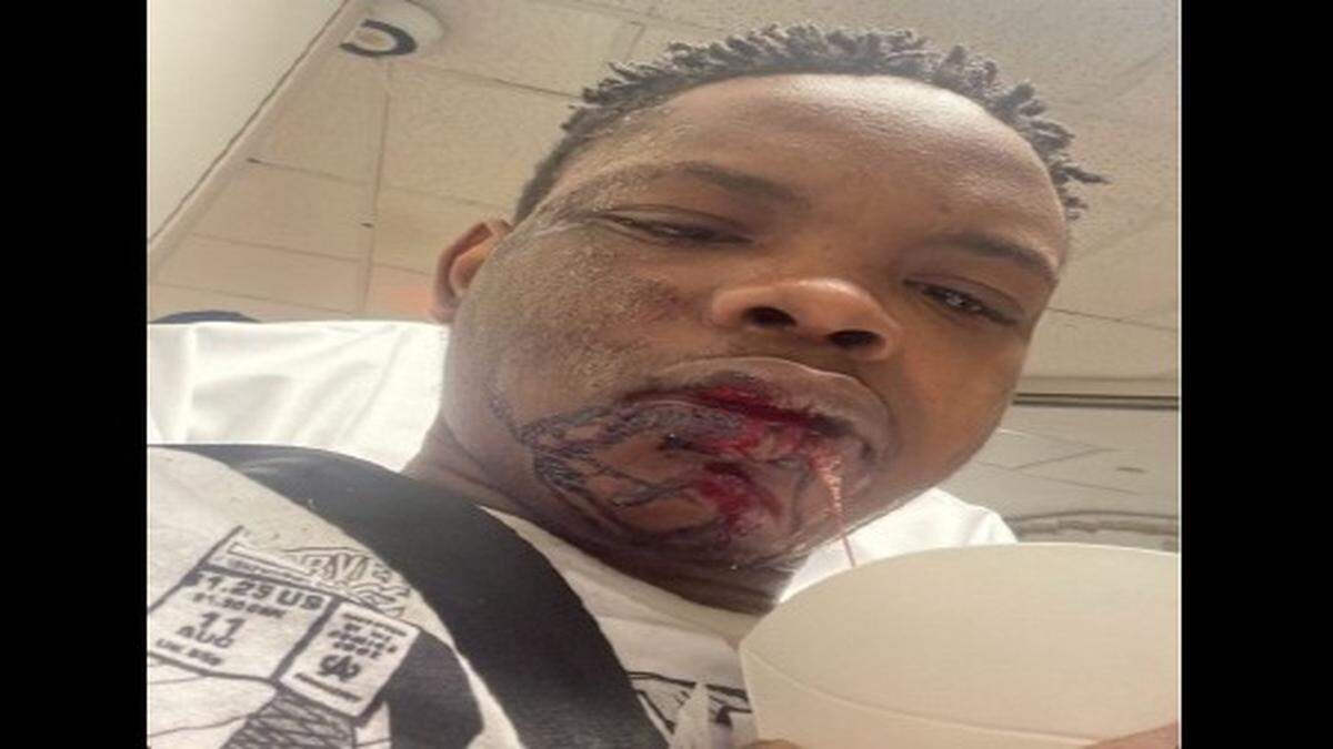 A photo of TJ Sanders after his December 2022 encounter with Raleigh police at a motel.