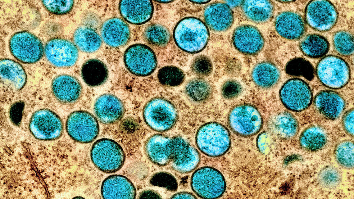 How NC health officials are fighting ‘huge’ racial disparity in monkeypox treatment