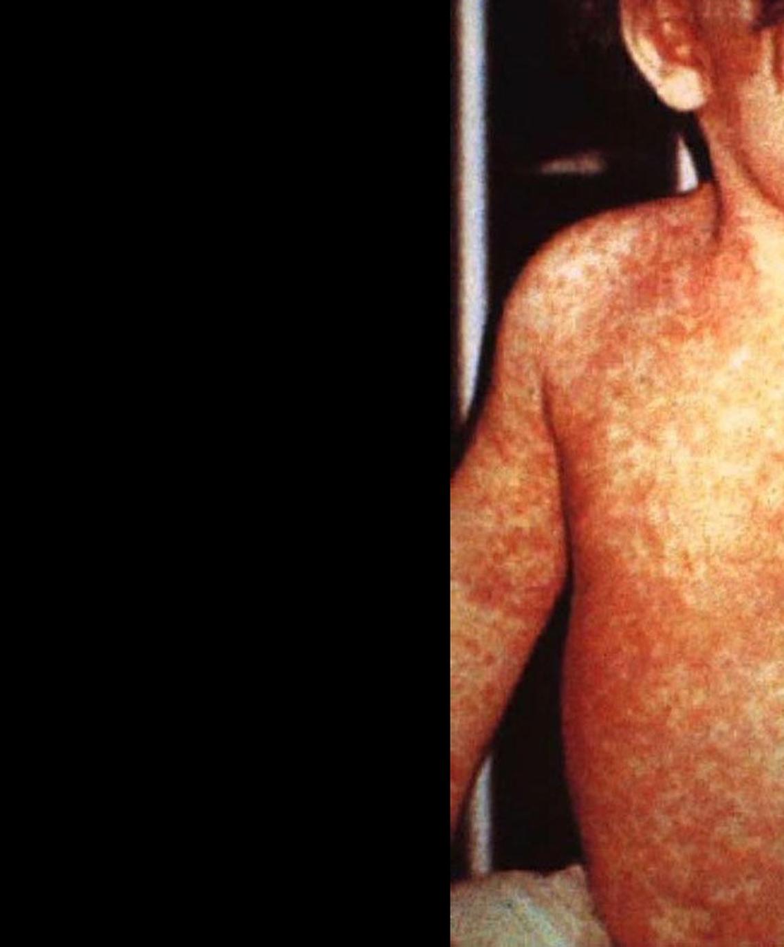 The rash is the best-known symptom of measles, but the patients first develop a fever, cough and runny nose, not unlike the flu.