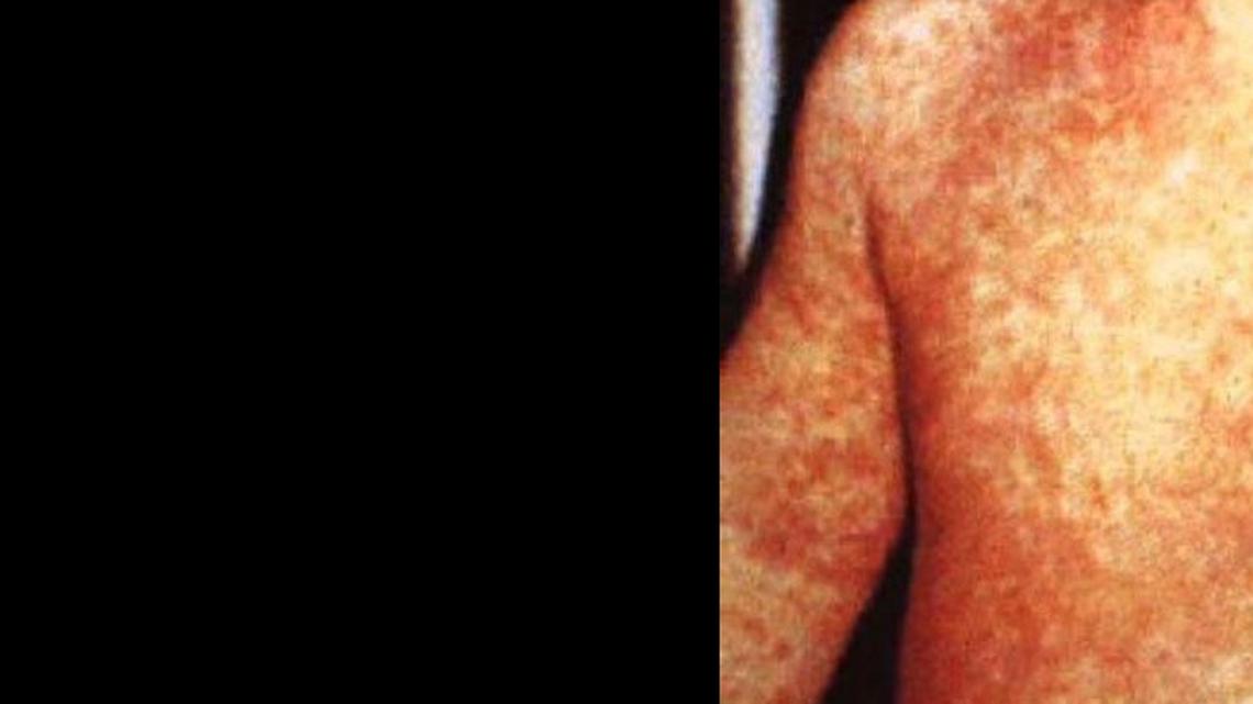 The rash is the best-known symptom of measles, but the patients first develop a fever, cough and runny nose, not unlike the flu.