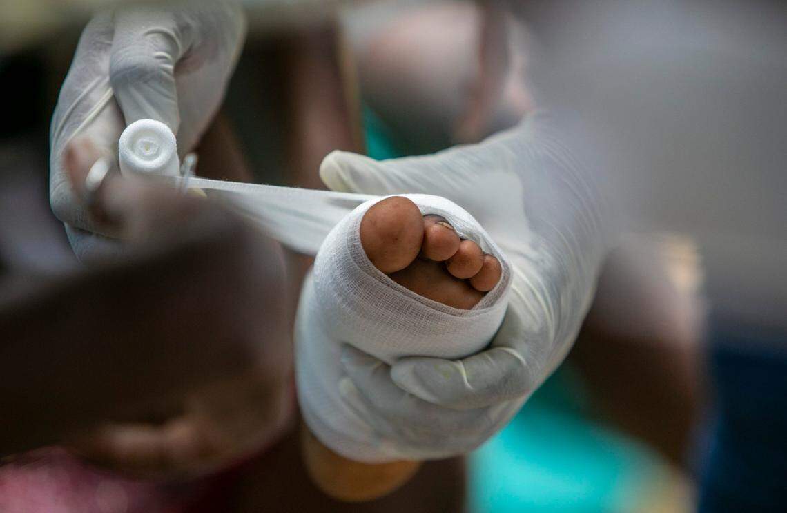 Les Cayes, Haiti, August 16 2021 - A young girls foot is bandaged by nurses at OFATMA hospital. Patients of OFATMA Hospital in Les Cayes are being cared for outdoors. Broken bones are common injuries, making the kidnapping of an orthopedic surgeon in the capital especially troubling.