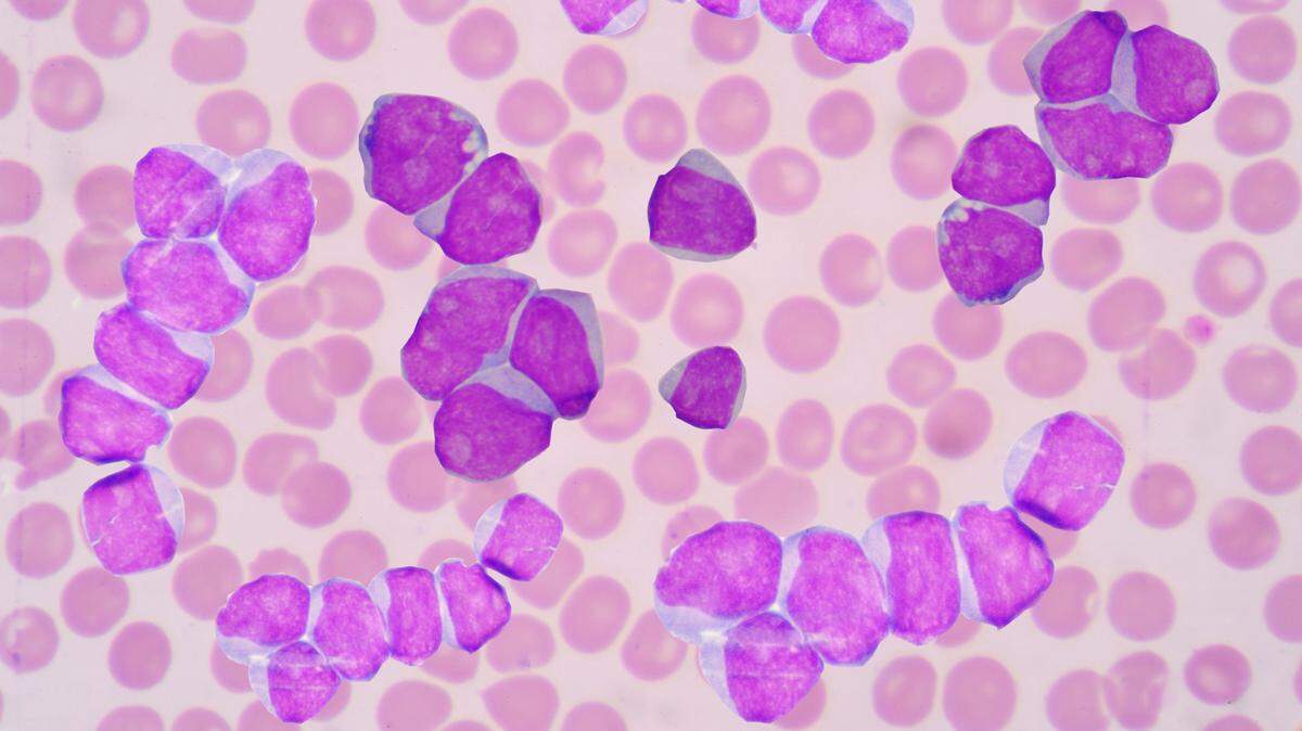Acute myelogenous leukemia (AML) is seen in this stock image. Duke researchers have discovered a new combination of drugs that is more effective than chemotherapy at killing acute myeloid leukemia cells in mice.