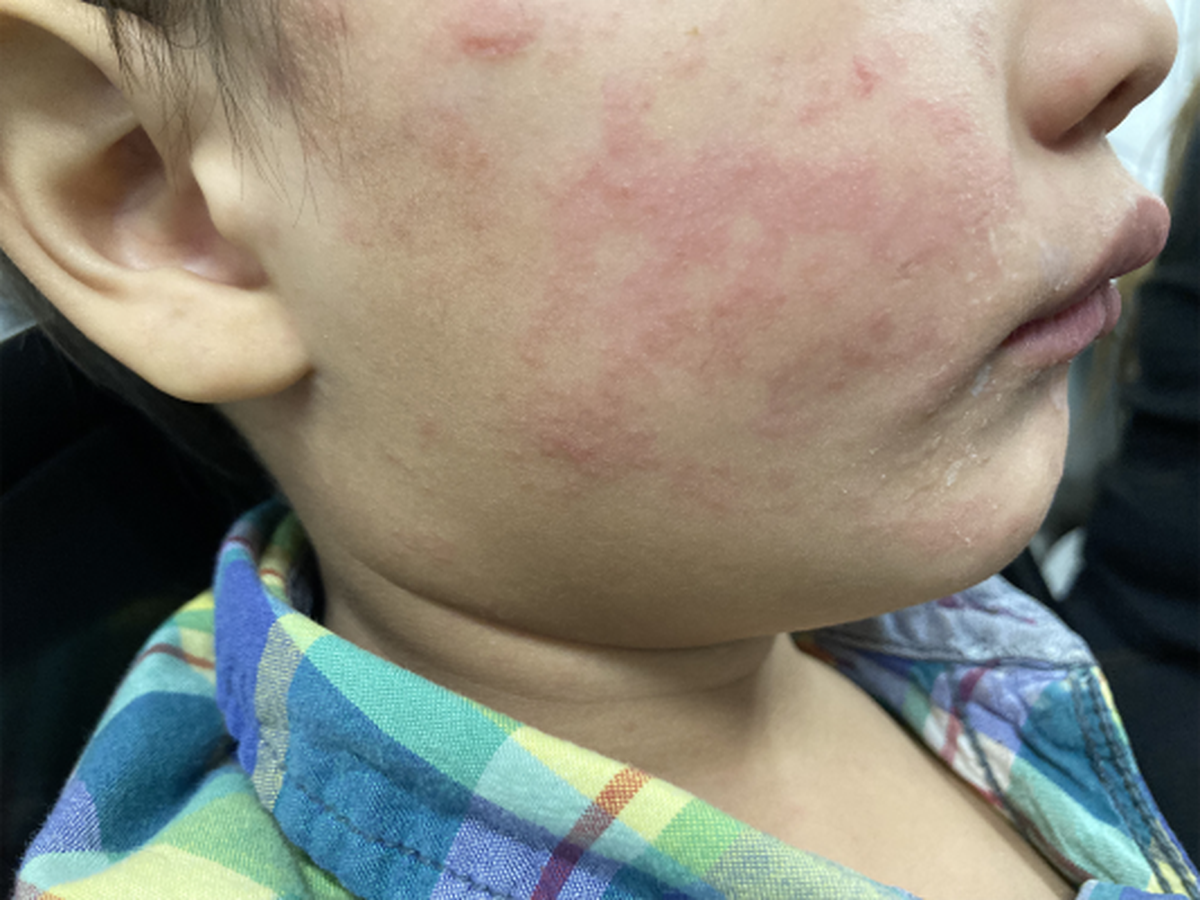 A rash on the cheek of a child infected with measles during a 2024 U.S. outbreak.