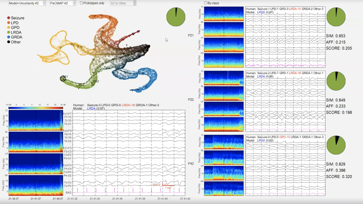 This is an example EEG reading that the Duke researchers’ AI tool studied and classified as a seizure-like signal.