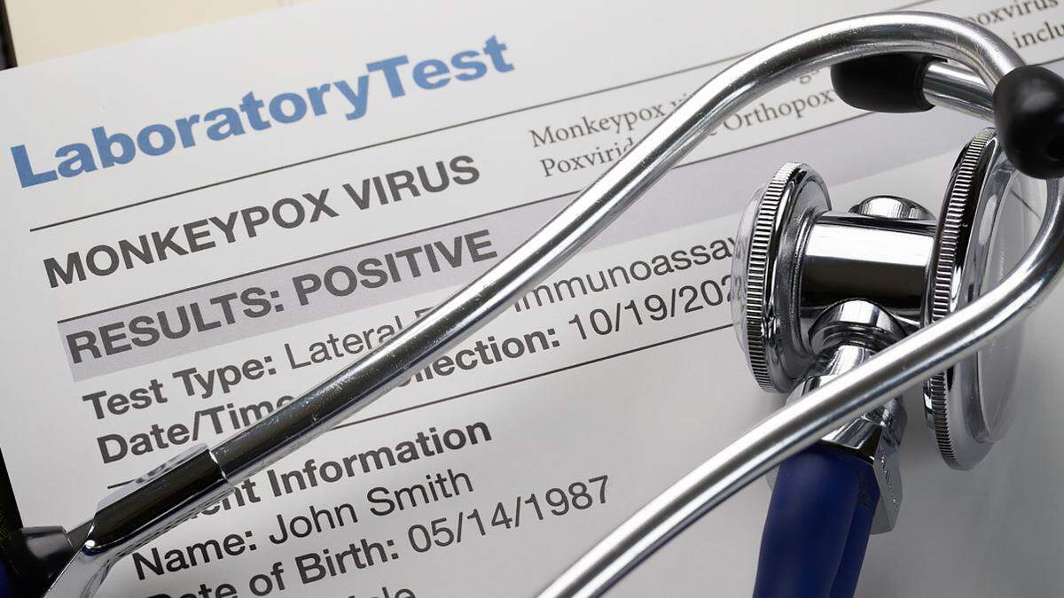 Monkeypox virus test results document with stethoscope. Wake County nurses vaccinated about 550 people against monkeypox at a walk-in clinic over the weekend.