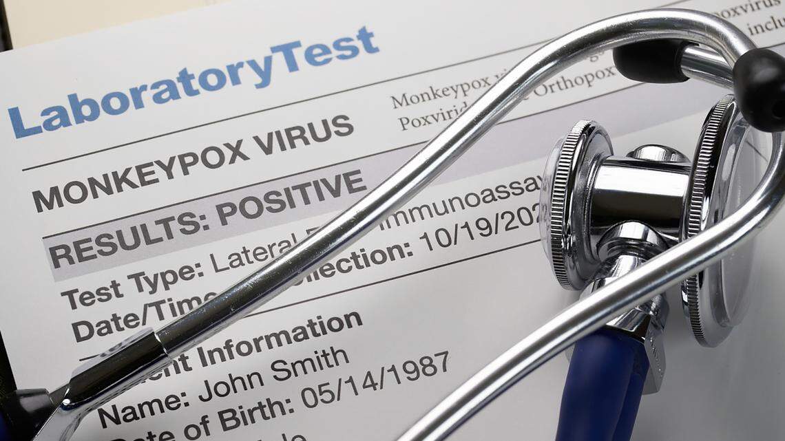 Monkeypox virus test results document with stethoscope.