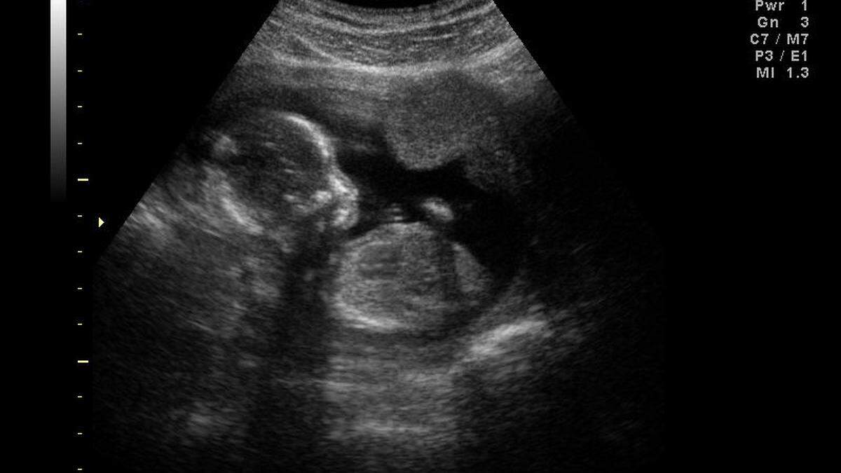North Carolina’s maternal mortality rate saw a 100% increase from 2019 to 2021 during the peak of the pandemic, data shows.