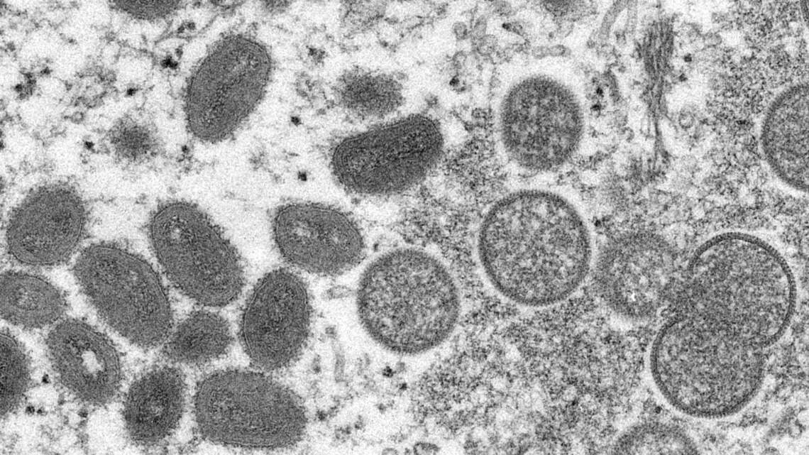 Mecklenburg County expands monkeypox vaccine eligibility. Here’s who can get it