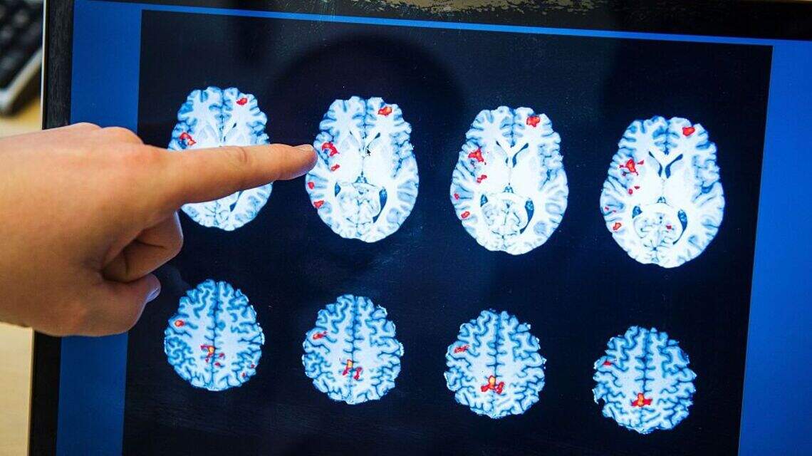 Berkeley Scientists Mapped the Brain’s “Sleep Switch” in Real Time and Found a Surprising Feedback Loop