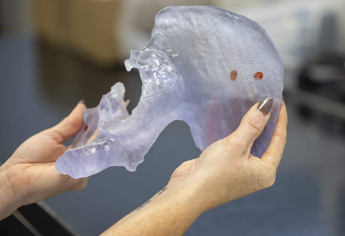 A polymer anatomic model of a hip, showing the pre-operative anatomy, produced by restor3d,  a company that specializes in making custom human body replacement parts in Durham, N.C. 