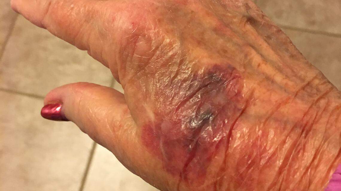 The North Carolina Republican Party released this photo showing the bruised hand of a poll volunteer who says she was assaulted by a Democratic candidate in Pitt County.