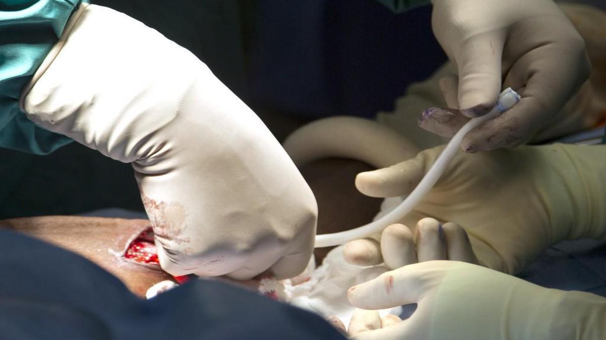 A bioengineered tissue developed by Humacyte and Duke University is used in a vein graft at Duke University Hospital in June 2013.