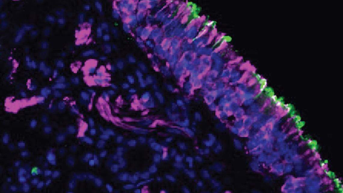 A biopsy of cells in the nose. Olfactory neurons in the nasal lining are stained in magenta.