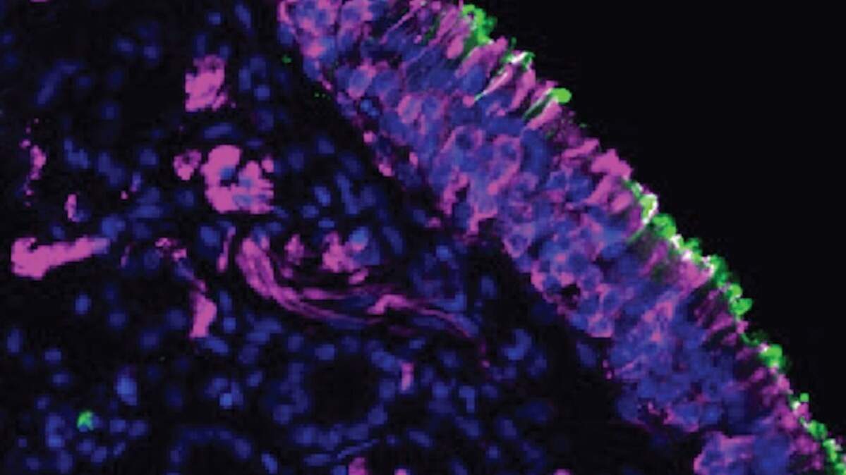 A biopsy of cells in the nose. Olfactory neurons in the nasal lining are stained in magenta.
