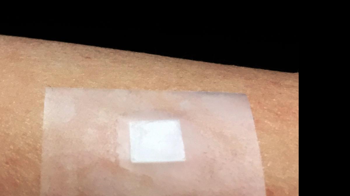 
A joint UNC-Chapel Hill and N.C. State University research team has designed what it calls a “smart insulin patch.” 
