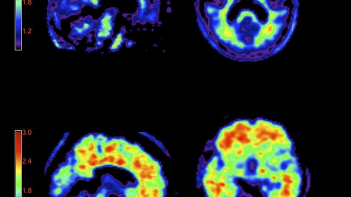 Images of a healthy person’s brain, above, show no buildup of plaque, while a brain afflicted with Alzheimer's, below, shows the plaque that marks the presence of the disease.