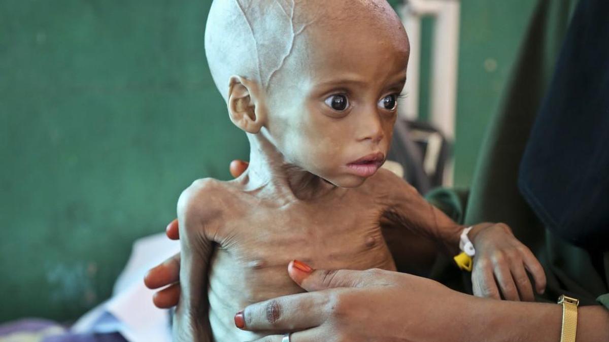 Acutely malnourished child Sacdiyo Mohamed, 9 months old, is treated at the Banadir Hospital after her mother Halima Hassan Mohamed fled the drought in southern Somalia.
