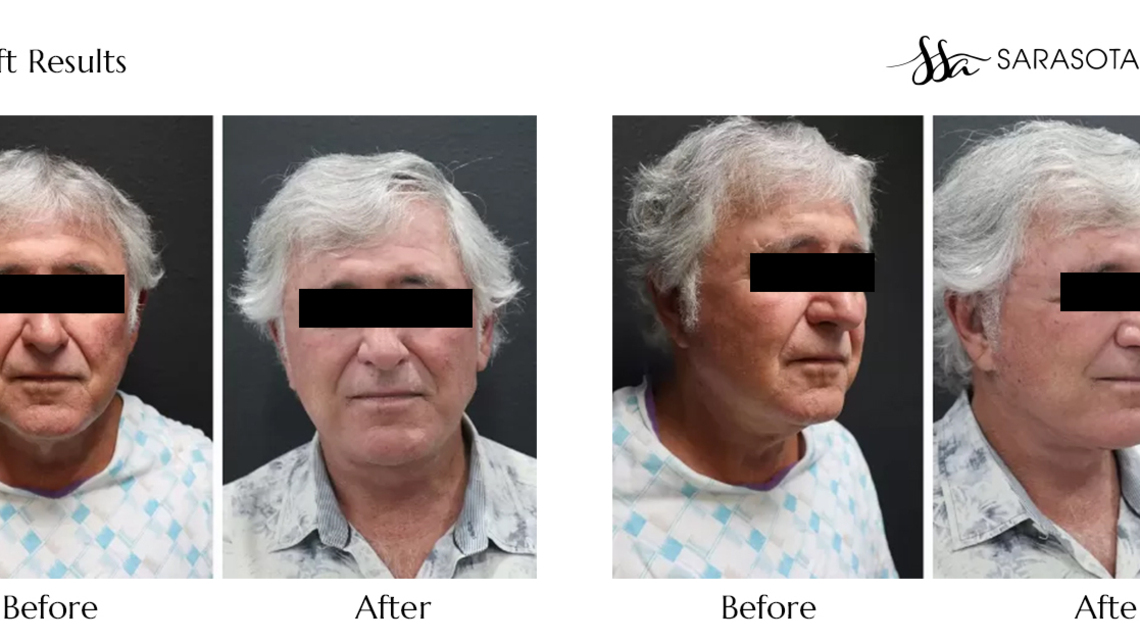 Who Does the Best Male Facelift Surgery in Sarasota? 